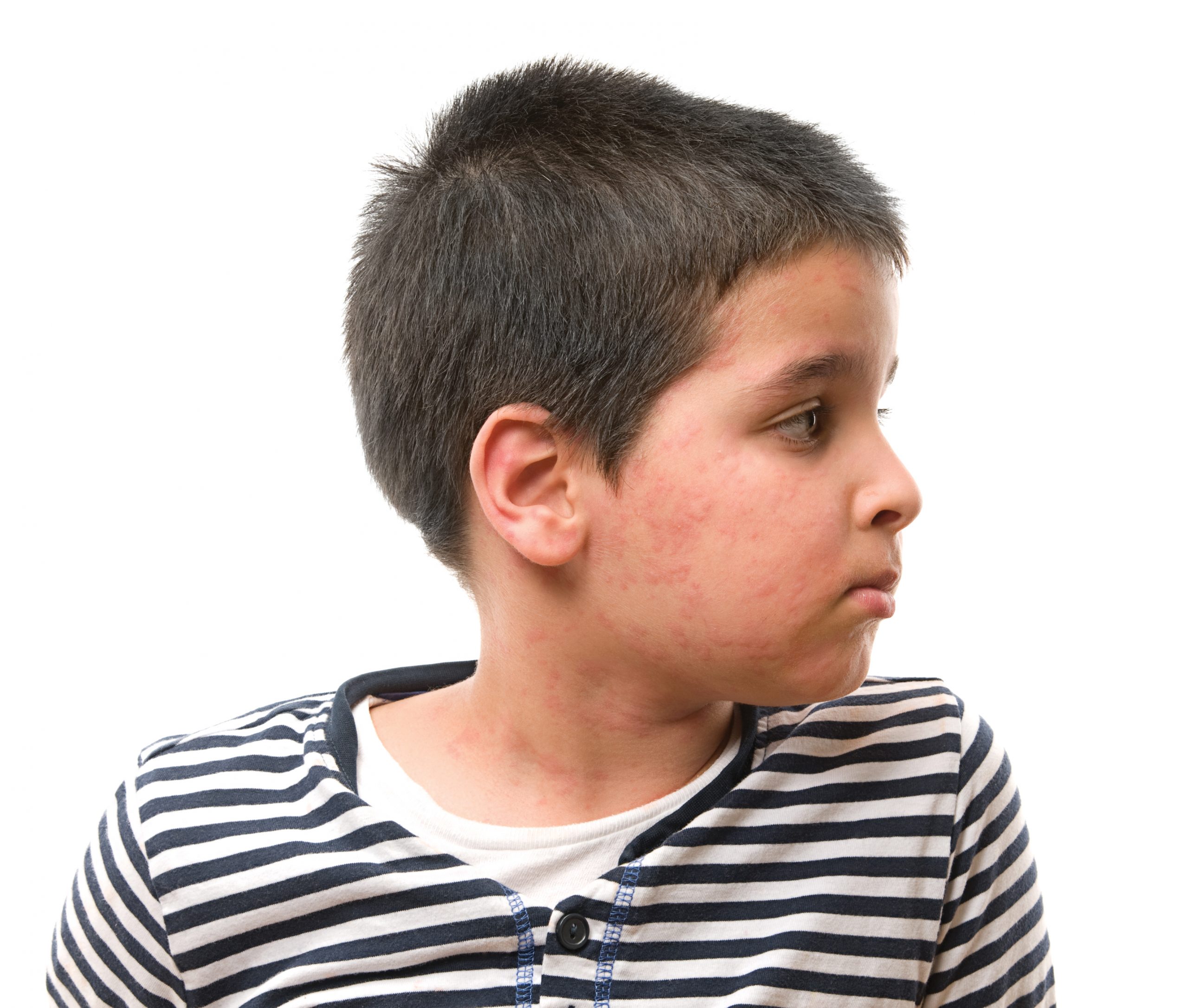 My son has skin rashes. Help! EducationWorld Ask the Doctor