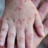 Monkeypox